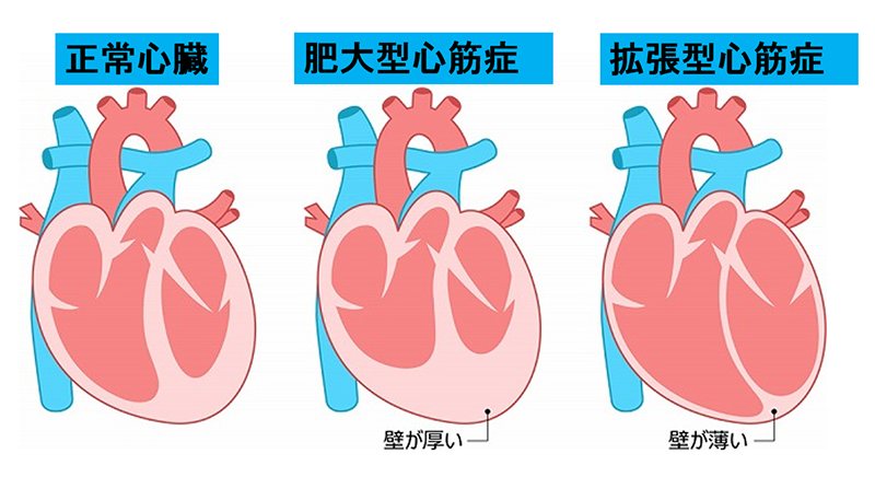 食事 心臓 肥大